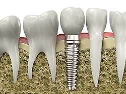 How a dental implant looks below the gumline