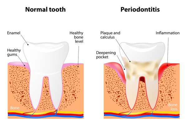 what a normal tooth looks like vs one with gum disease